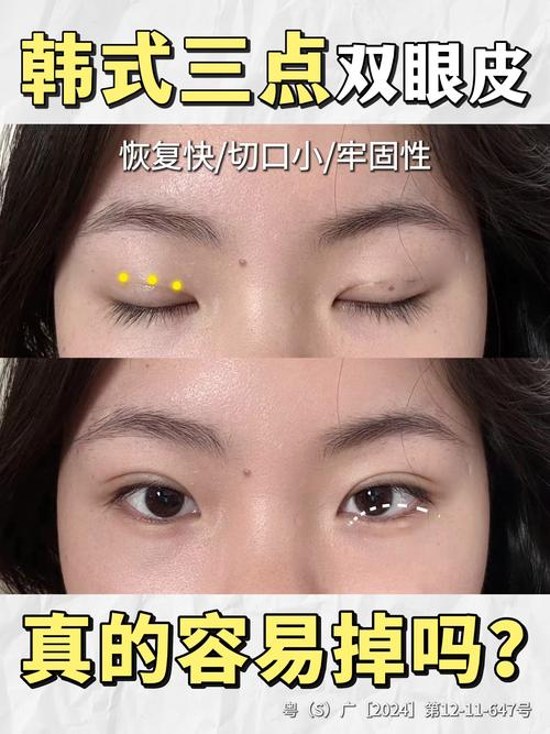 定点双眼皮手术详解与正规医疗美容机构选择指南