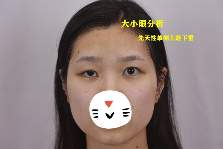 上睑下垂矫正：科学选择机构与安全变美指南