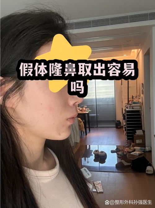假体隆鼻全解析:材料选择、手术流程与注意事项